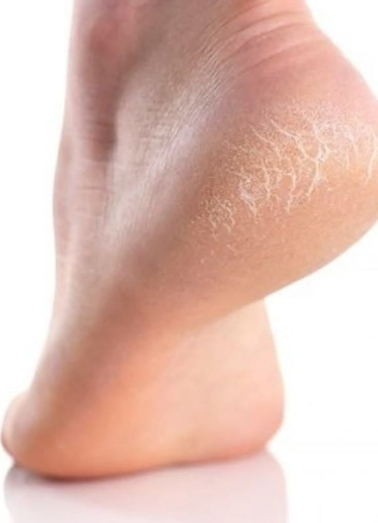 Care for calluses and cracked heels