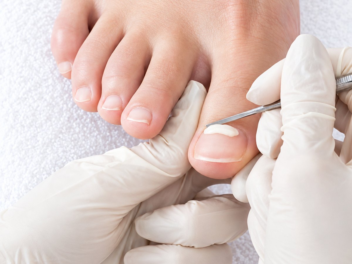 Onyfix nail shaping